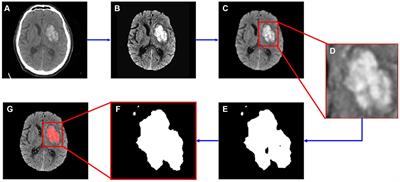Automatic segmentation of hemorrhagic transformation on follow-up non-contrast CT after acute ischemic stroke